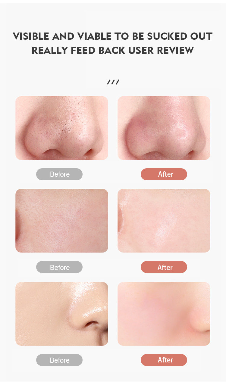 Black Head Remover - Inclusief app & Camera